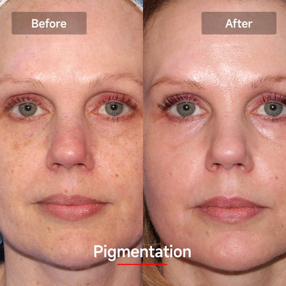Megelin LASER&LED Light Therapy Mask