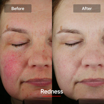 Megelin LASER&LED Light Therapy Mask